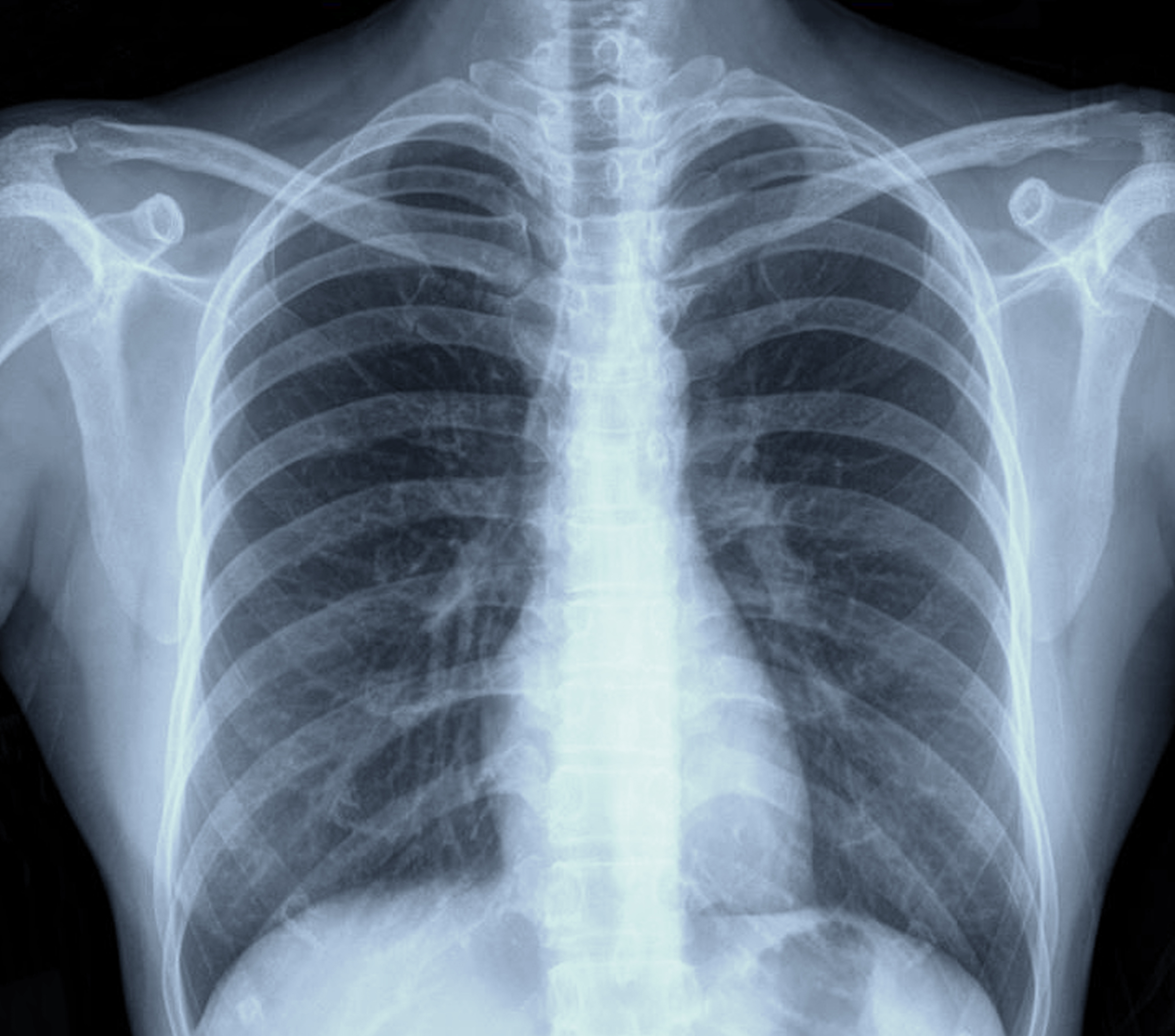 Can Deep Learning Assessment of X-Rays Improve Triage of Patients with Acute Chest Pain?