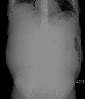 Image IQ: 45-year old presenting with gradual abdominal swelling