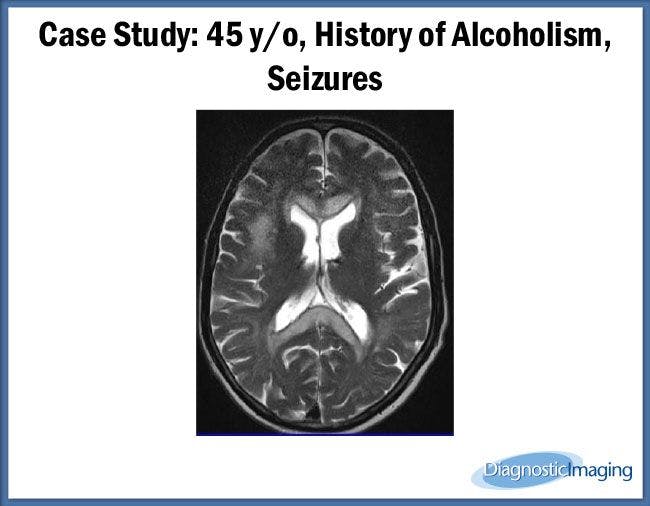 45 y/o, History of Alcoholism, Seizures