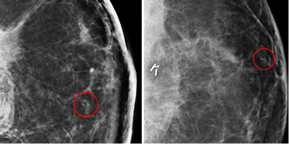 Post-Mastectomy Bilateral Breast MRI Detects Asymptomatic Cancers