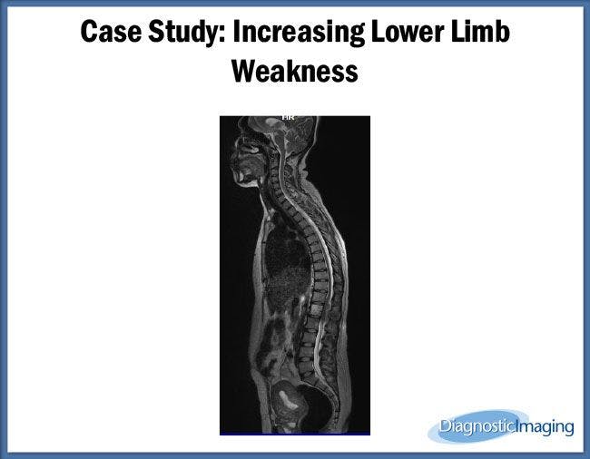 Increasing Lower Limb Weakness