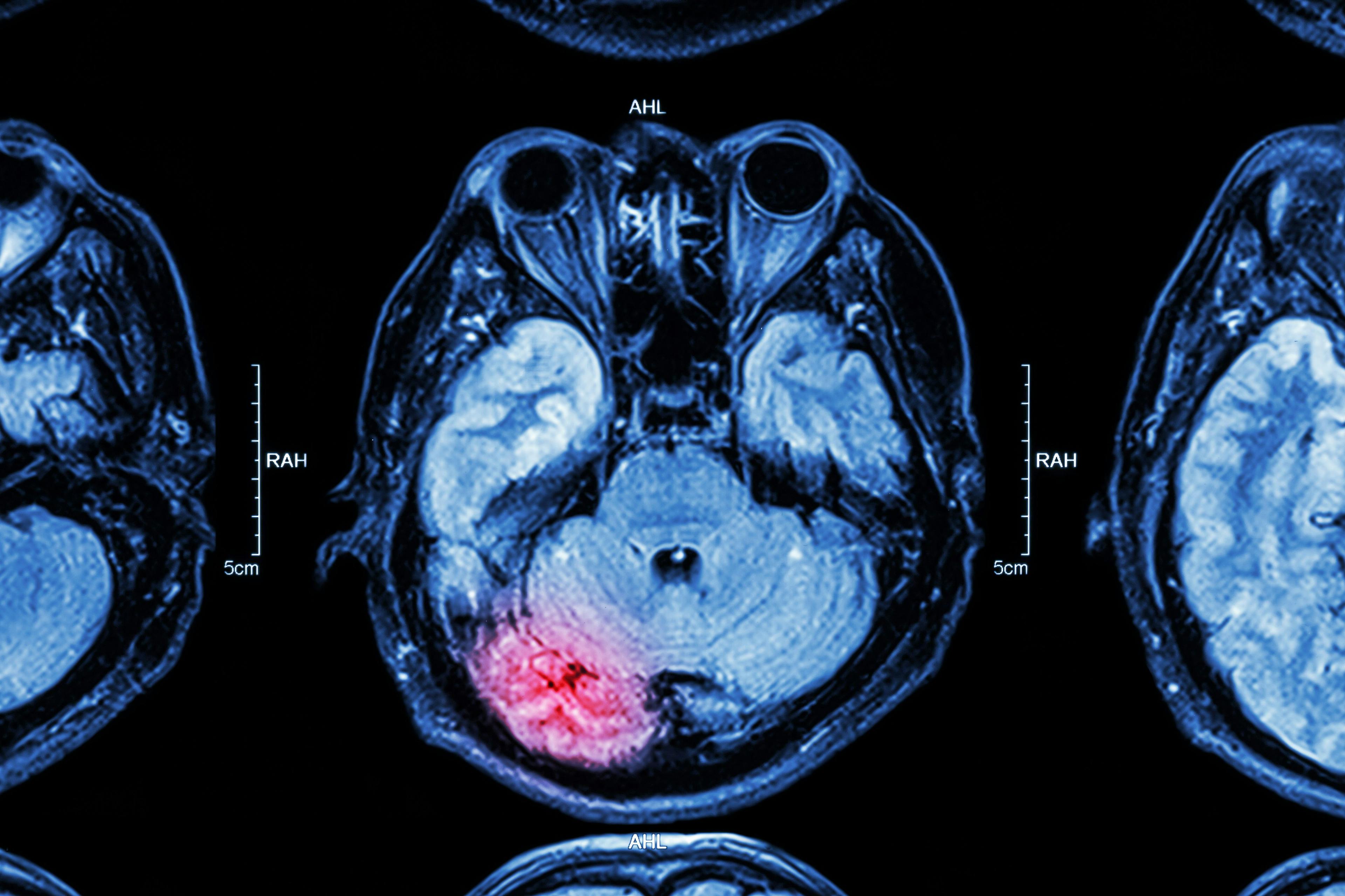 Algorithm Can Detect Intracranial Hemorrhage in CT Without Medical Annotation 
