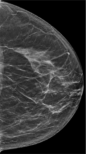 Tomosynthesis Better Long-Term than Digital Mammography for Breast Cancer Screening