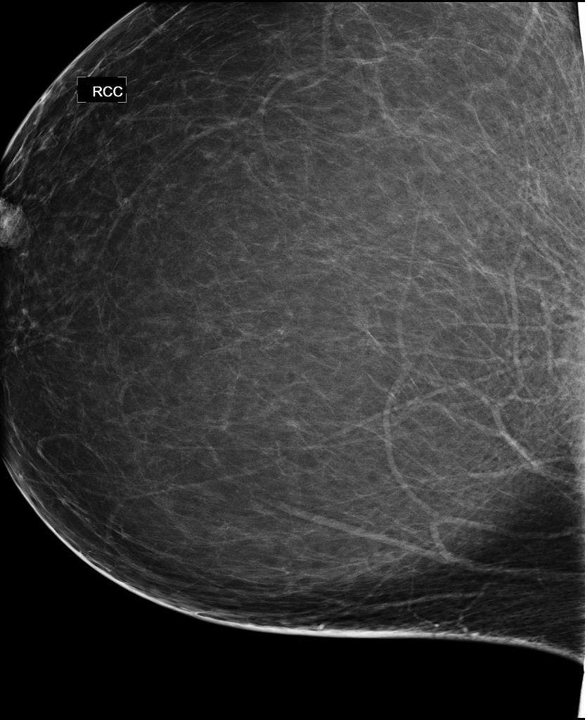 Image IQ: 45-year-old Female, Routine Screening Mammogram Abnormality