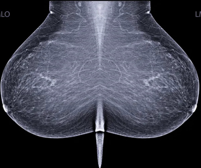 Biennial Mammography Over Annual Mammography?: USPSTF Issues Updated Breast Cancer Screening Recommendations