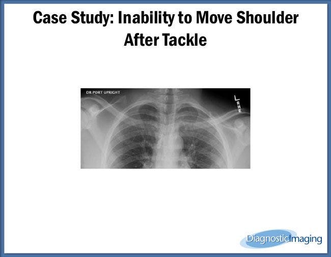 Inability to Move Shoulder After Tackle