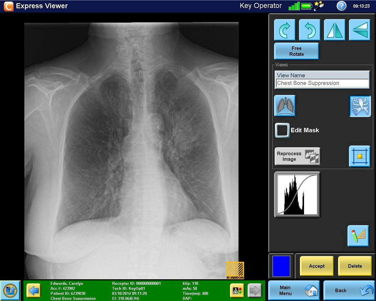 FDA Approves Carestream’s Bone Suppression Software for CR, DR Systems