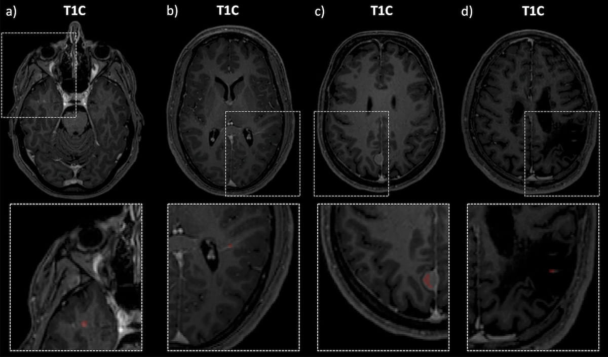 Can AI Bolster MRI Lesion Detection and Segmentation in Patients with Multiple Sclerosis?