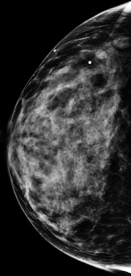 Image IQ: 42-year-old Woman with Recent Stage III Malignant Melanoma Diagnosis