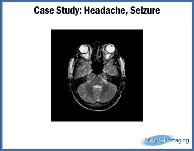 Headache, Seizure