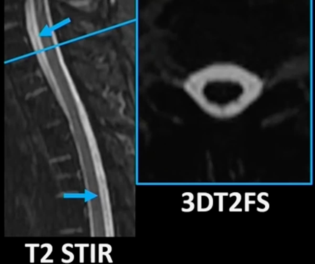 Spine Radiology Insights on Venous Fistula Localization and Finding Cerebrospinal Fluid Leaks