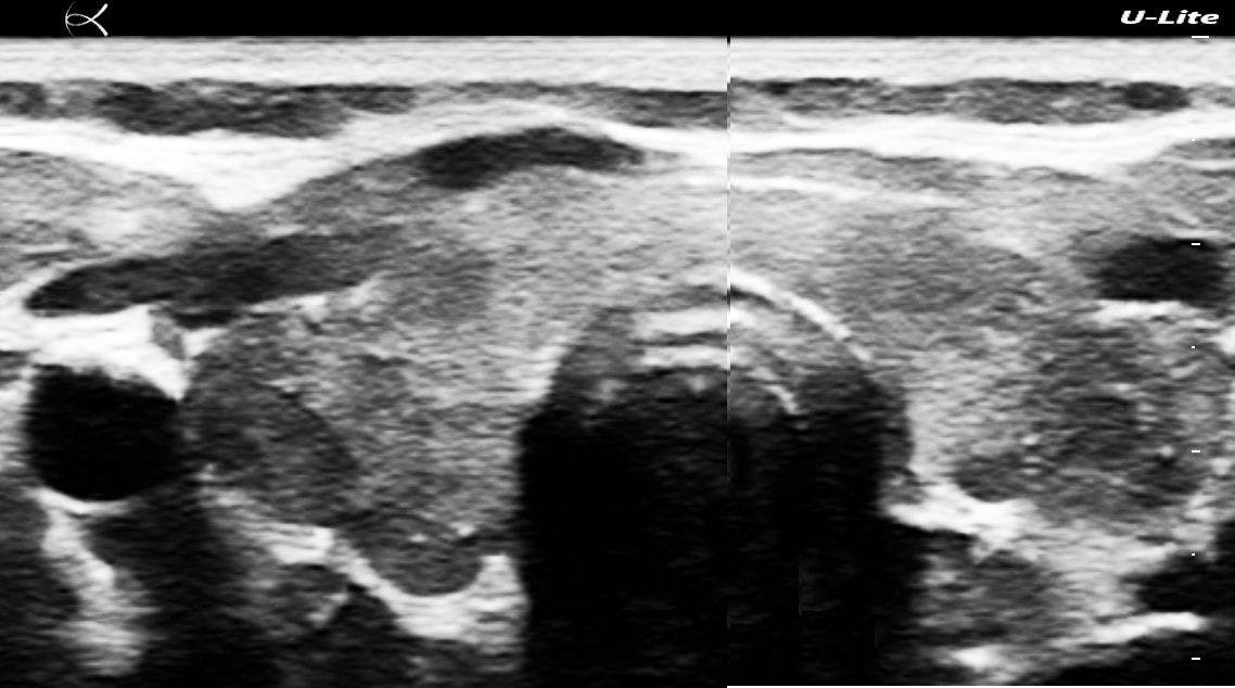Figure 5A. Split-screen of both lobes (top) views of the thyroid.
