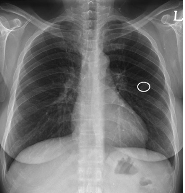 Images in a 48-year-old woman with 15-mm biopsy-proven metastatic carcinoma of parotid duct origin. Chest radiograph with DLD-generated true-positive mark on nodule (circle). With aid of DLD system, all observers detected the nodule by recognizing the marked nodule as a true-positive finding.

Credit: RSNA