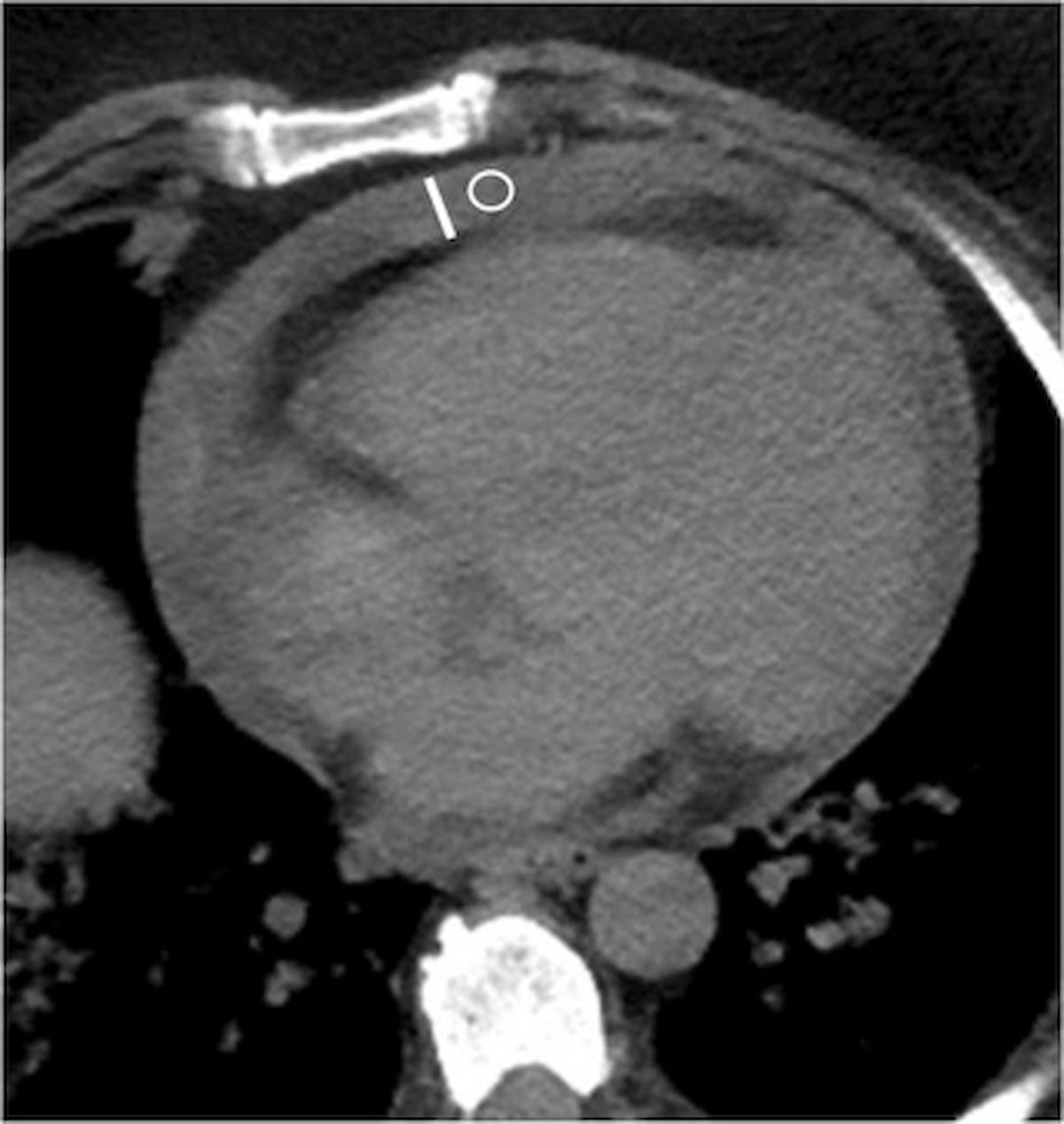 What a New Chest CT Study Reveals About Pericardial Effusion and COVID-19