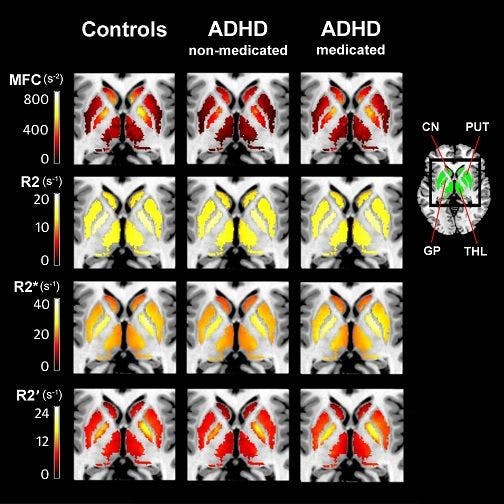 MRI Detects Low Brain Iron Levels in Medication-Naive ADHD Patients