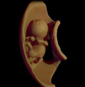 MRI Helps Create 3D Model of Fetus, May Detect Abnormalities