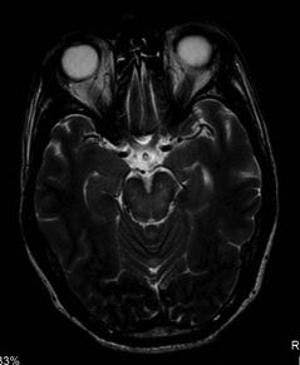 Imaging Shows Brain Changes Caused by Zika 