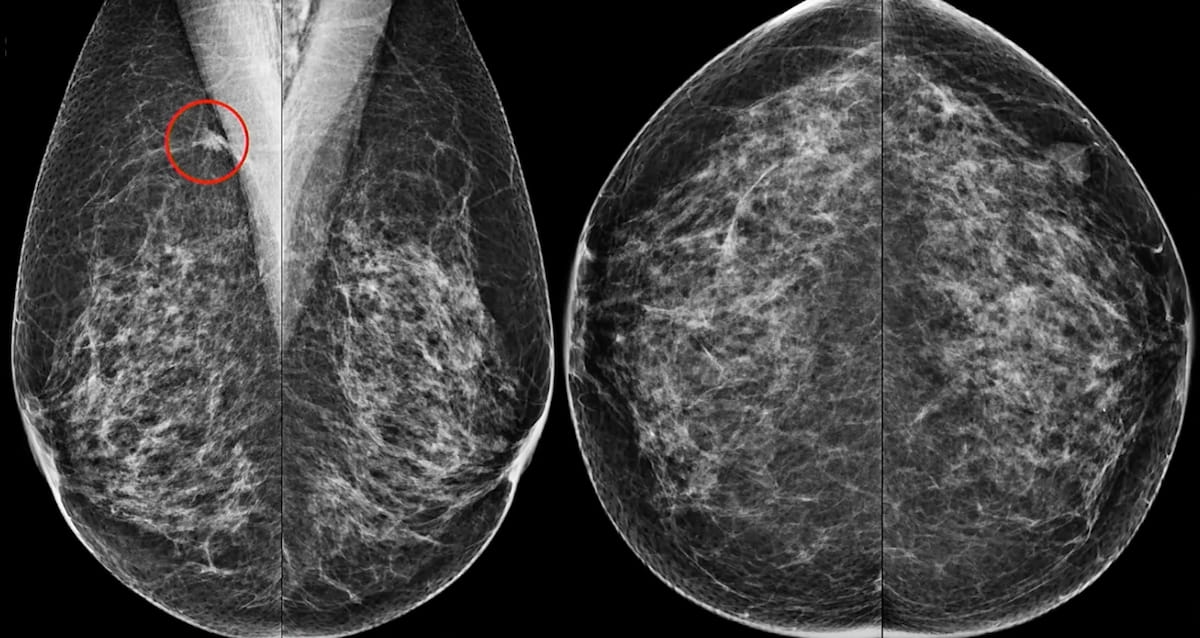 Study: Contrast-Enhanced Mammography Changes Surgical Plan in 22.5 Percent of Breast Cancer Cases