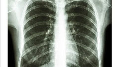 AI Tool Scores COVID-19 Lung Infection Severity