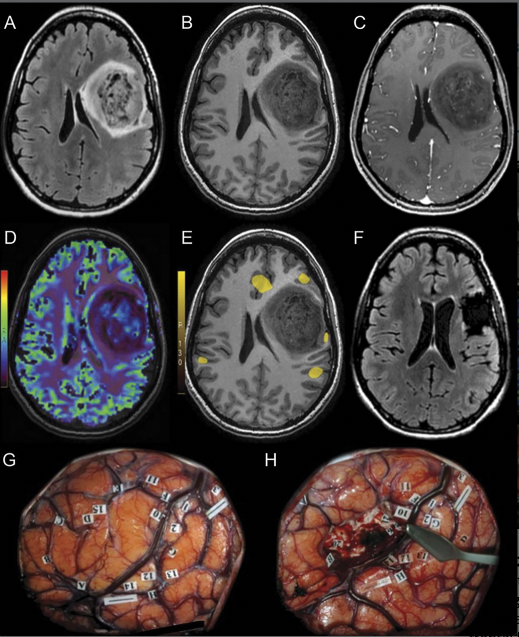 MRI scans and direct cortical stimulation technique in a 32-year-old woman with a grade II astrocytoma. Preoperative MRI shows a well-delineated mass within the left frontal lobe on, A, three-dimensional fluid-attenuated inversion recovery and, B, precontrast three-dimensional T1-weighted scan. C, Patchy and faint contrast enhancement is observed on postcontrast three-dimensional T1-weighted MRI scan. D, Cerebral blood volume map shows a globally hypoperfused tumor with hyperperfused foci.

Credit: RSNA