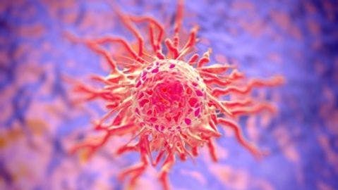 AI Algorithm Detects Lymph Node Metastasis in Cervical Cancer on MRI