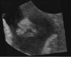 Ultrasonographic Screening for Fetal Malformations