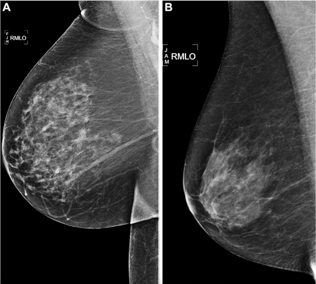 Study Assesses Ability of Mammography AI Algorithms to Predict Breast Cancer Risk