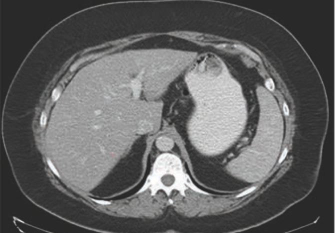 Multi-Parametric CT Offers Earlier Detection for Common Liver Disease