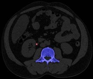 Dual-energy CT edges toward clinical implementation and wider acceptance