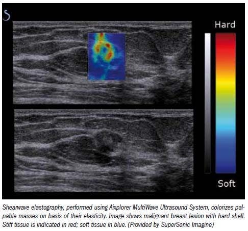 Shearwave elastography improves breast lesion Dx