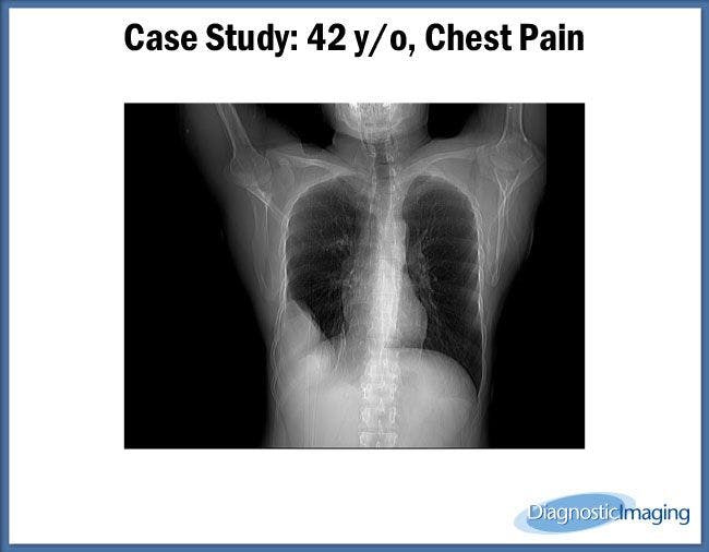 42 y/o, Chest Pain