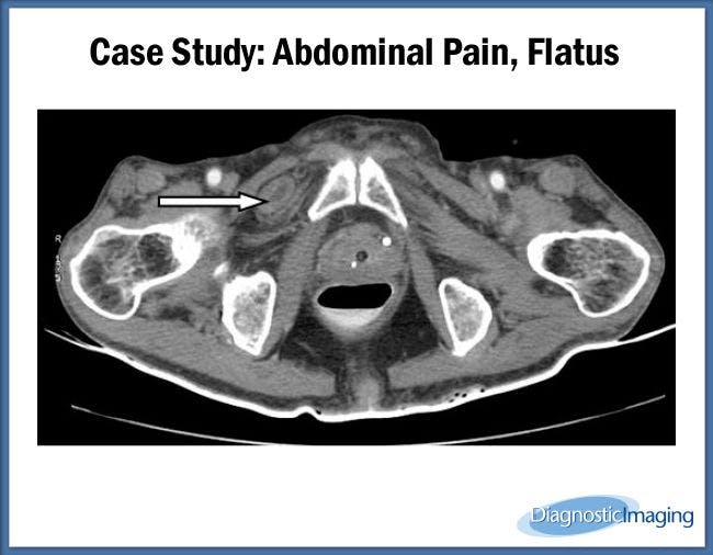 Abdominal Pain, Flatus