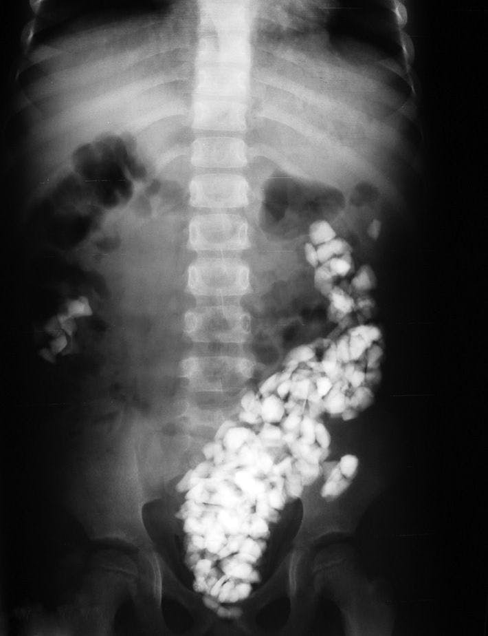 Image IQ: Patient Presenting with Multiple Abdominal Radio-Opacities
