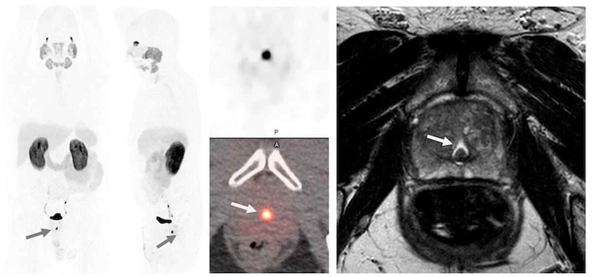 What Post-Void MRIs May Reveal About Midline Radiotracer Activity on PSMA PET/CT