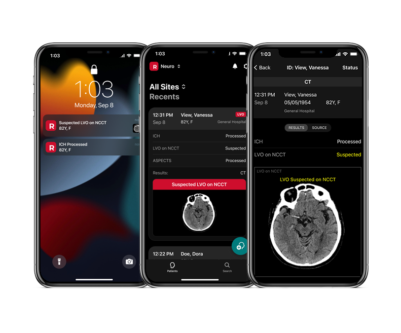 RapidAI Gets FDA Nod for AI Assessment of Non-Contrast CT for Acute Stroke Triage