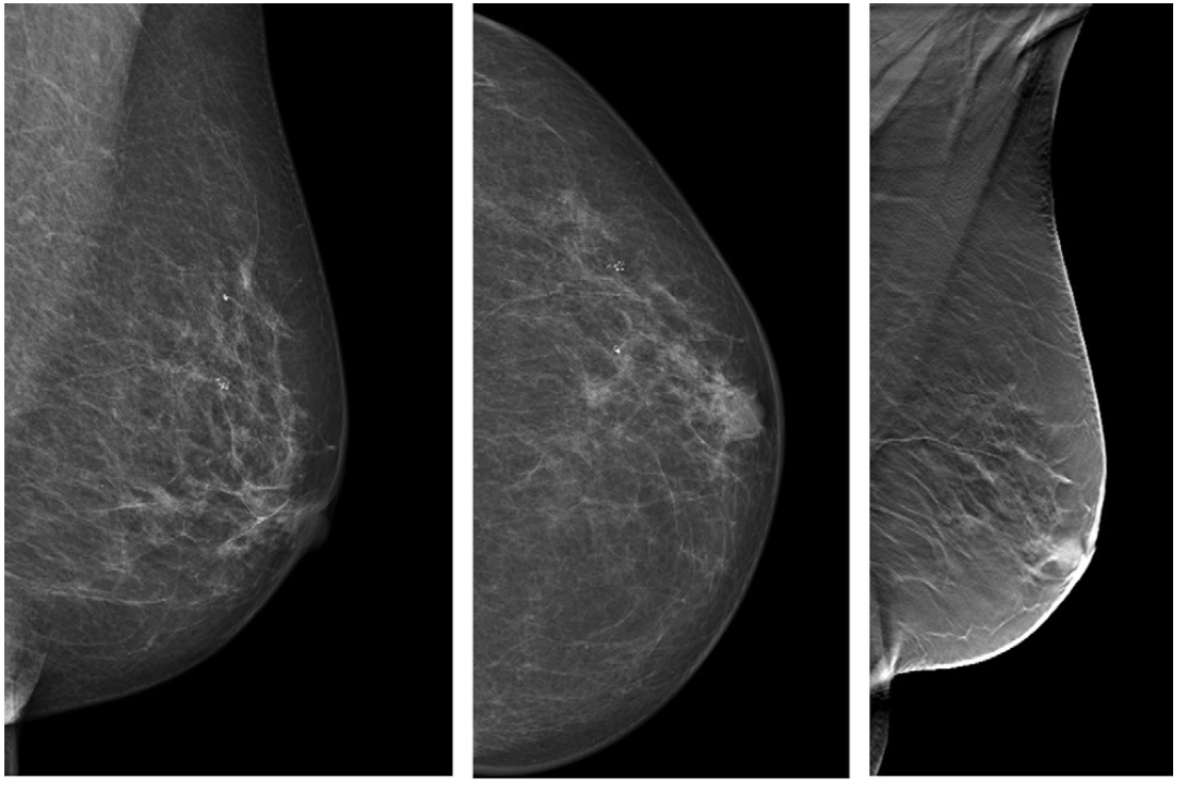 Interval Cancer Rate Lower with Digital Breast Tomosynthesis