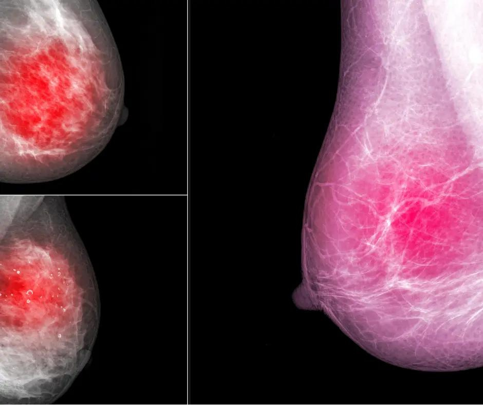 New Meta-Analysis Says MRI is Best Supplemental Imaging for Dense Breasts