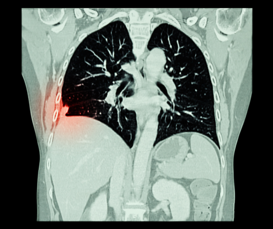 Study Finds Low Use of LDCT Among Eligible Candidates for Lung Cancer Screening