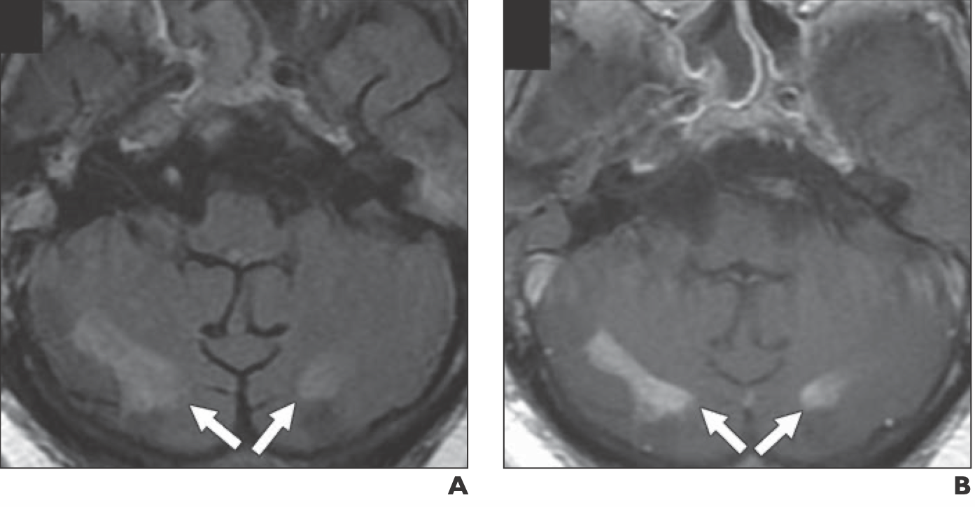 63-year-old woman with history of hypertension and type 2 diabetes mellitus who presented with coronavirus disease (COVID-19) pneumonia complicated by acute respiratory distress syndrome.

A, Axial FLAIR MR image shows areas of T2 prolongation in posterior inferior cerebellar hemispheres (arrows).
B, Contrast-enhanced T1-weighted image shows enhancement of areas with T2 prolongation (arrows).

Courtesy: American Journal of Roentgenology