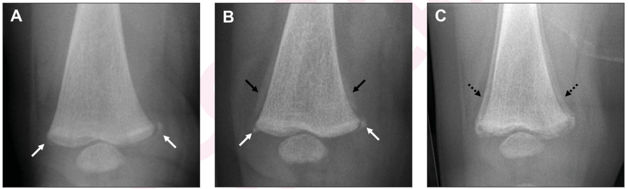 Anterior-posterior radiographs of the right femur of a 4-month-old girl not moving her right leg. Chest bruises were also present. A classic metaphyseal lesion (white arrows) was demonstrated at presentation (A). Subsequent perios- teal reaction (black arrows) with continued visualization of the classic metaphyseal lesion (white arrows) 6 days later (B); progression of healing (dotted black arrows) was observed 18 days following presentation (C).

Credit: American Journal of Roentgenology