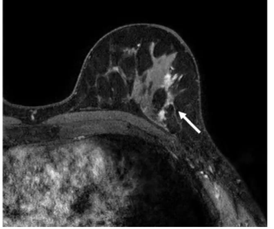 Five Takeaways from New Breast MRI Literature Review