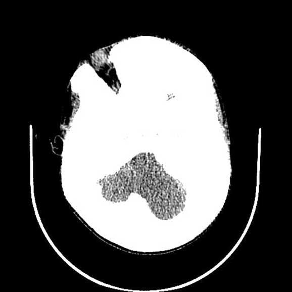 Fibrous Dysplasia of the Skull (Leontiasis Ossea)