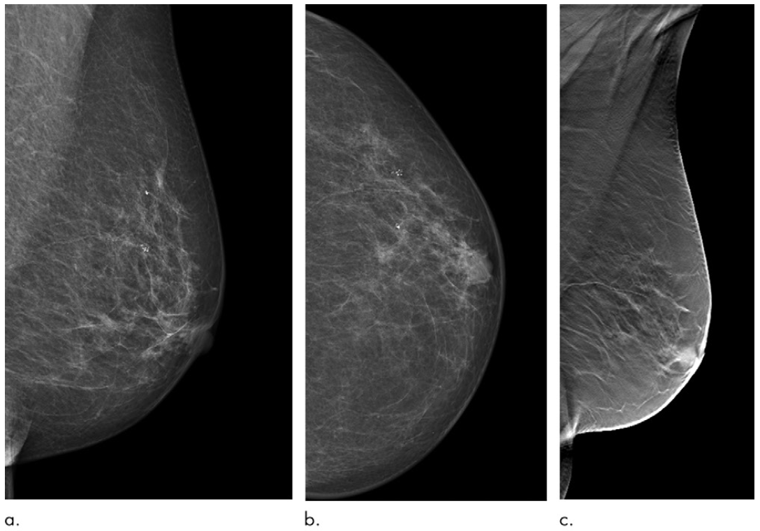 Images in a 72-year-old woman who was diagnosed with a 13-mm lymph node-negative invasive lobular carcinoma luminal B–like human epidermal growth factor receptor 2 breast cancer 18 months after a screening negative for cancer in the Malmö Breast Tomosynthesis Screening Trial. (a) Mediolateral oblique and (b) craniocaudal digital mammography (DM) images at screening. The slight retraction of the nipple was unchanged compared with previous DM screening images. (c) Digital breast tomosynthesis at screening.

Courtesy: RSNA