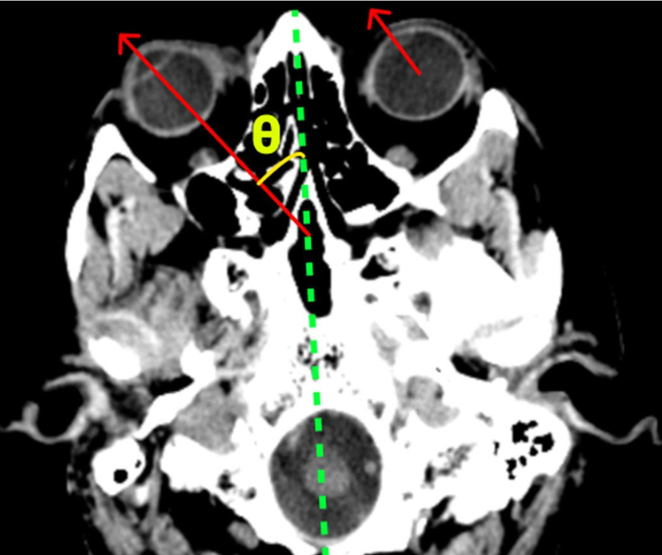 Study Suggests AI Enhances Non-Contrast CT Detection of Large Vessel Occlusion