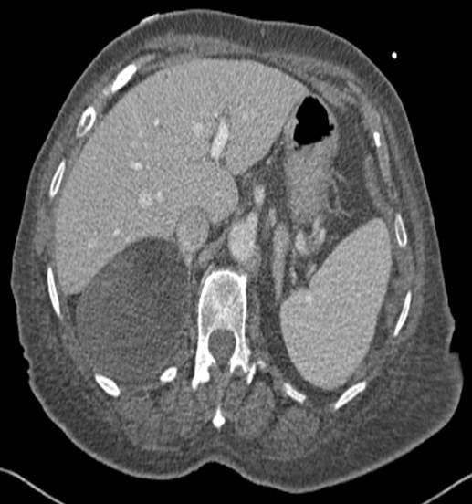 Image IQ: 85-year-old Male, History of Aortic Stenosis 