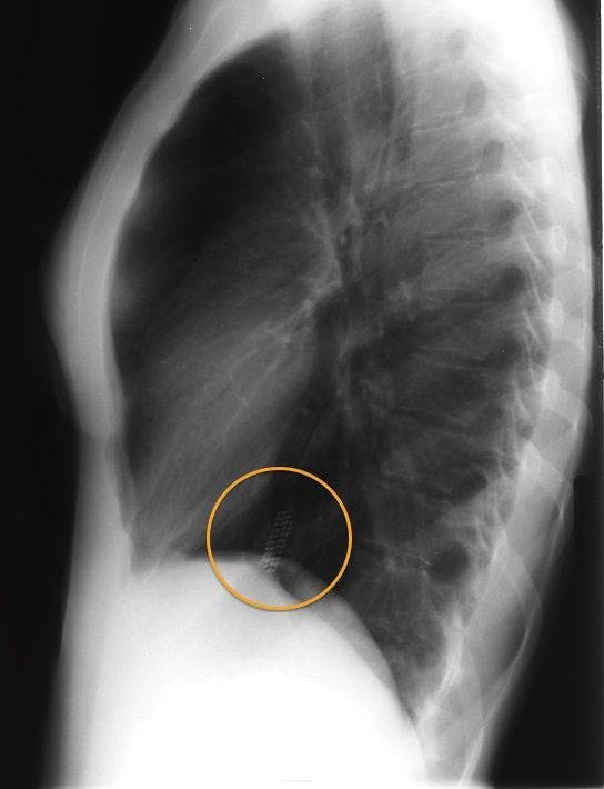 Swallowed toothbrush on chest radiograph