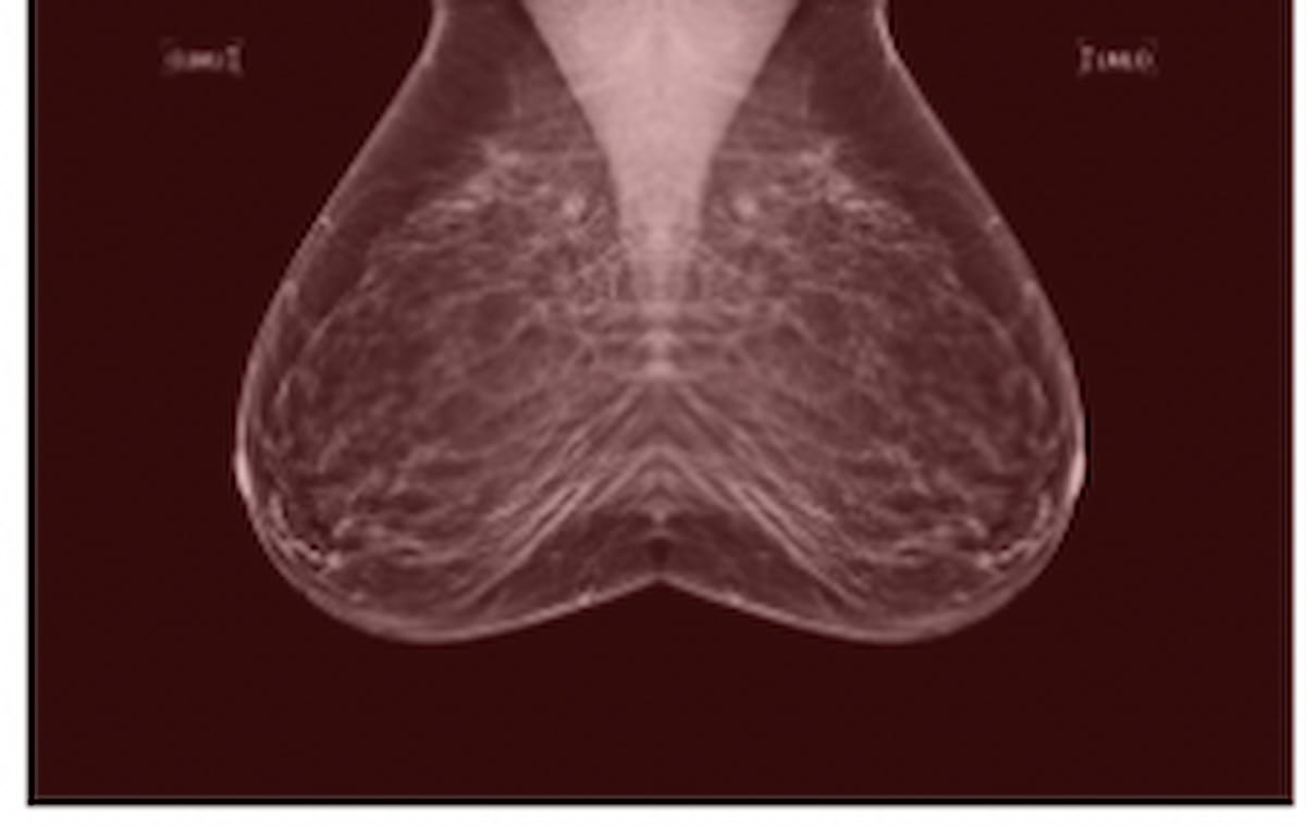 Mammography-Based Deep Learning Model May Help Detect Precancerous Changes in High-Risk Women