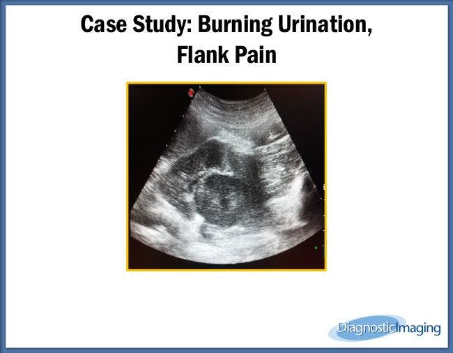 Burning Urination, Flank Pain