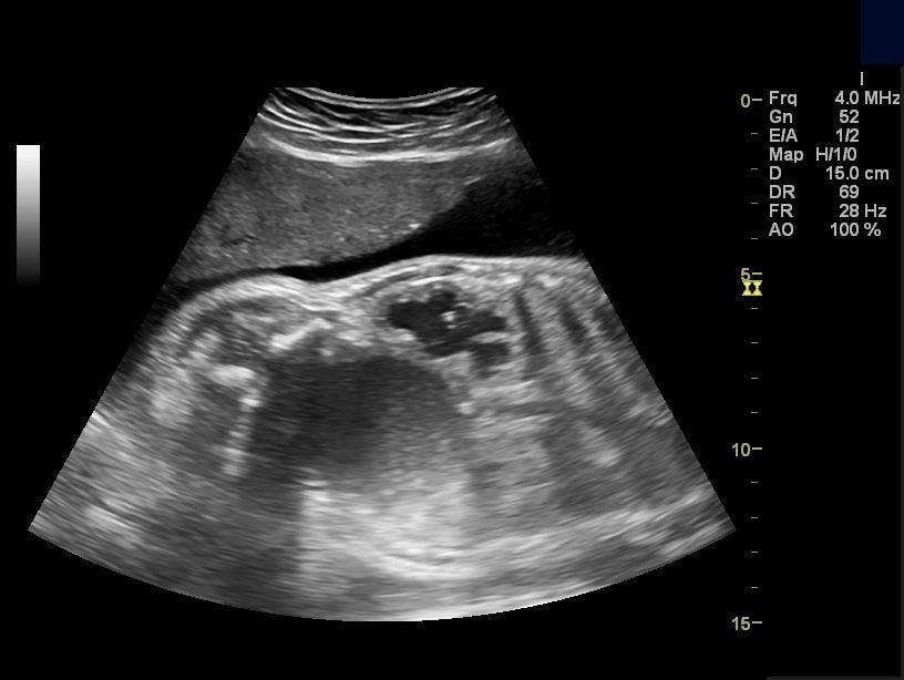 Image IQ: 32-week Female Fetus with Anomaly