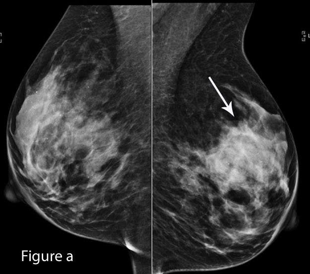 Image IQ: Contralateral Breast after Cancer Diagnosis